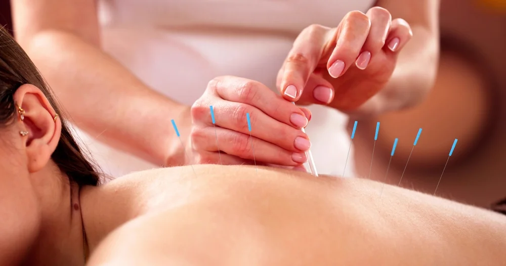 Dry Needling